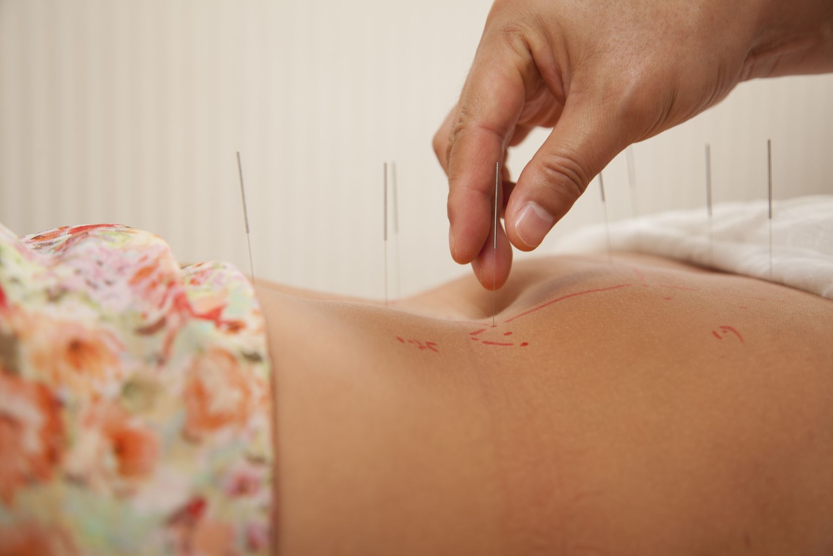 Acupuncture for Fatty Liver: A Natural Approach to Liver Health